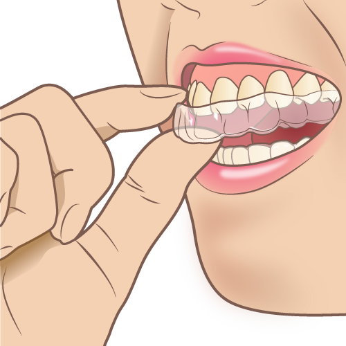 mouthpiece_orthodontic