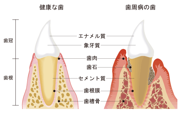 i_ld_periodontal_disease